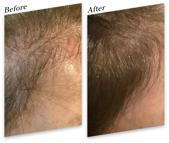 70代 女性 2回 Before After