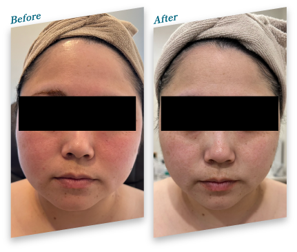 Before After