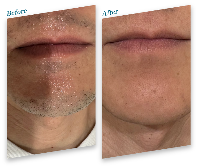 Before After