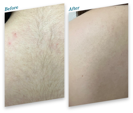 Before After